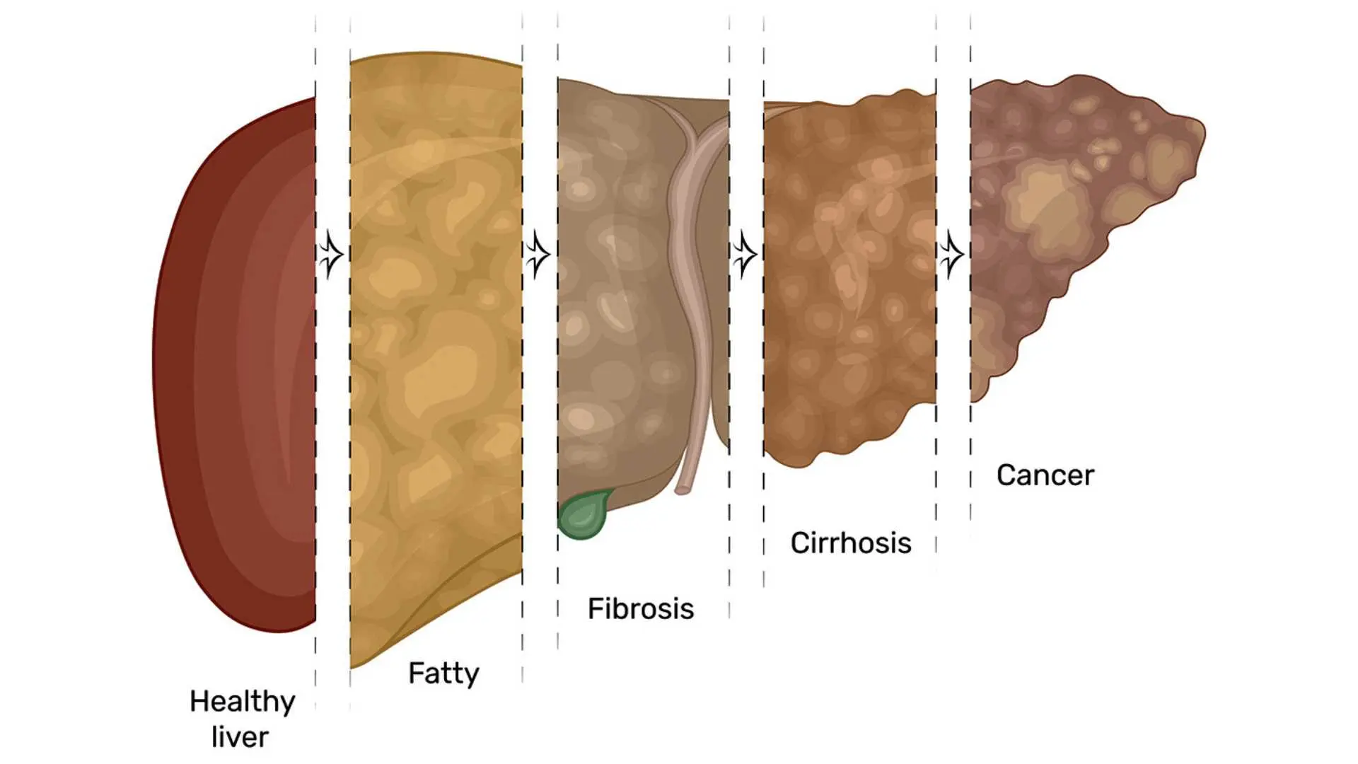 NAFLD